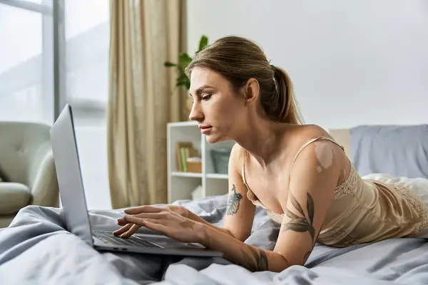 A young woman with vitiligo and a tattoo lies on her bed, working on her laptop. — Stock Photo