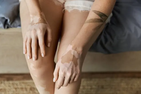 A young woman with vitiligo sits in her apartment bedroom, her hands resting on her legs. — Stock Photo