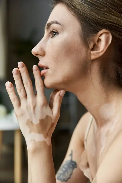 Eine junge Frau mit Vitiligo sitzt in ihrem Schlafzimmer, die Hand am Kinn, verloren in Gedanken. — Stockfoto