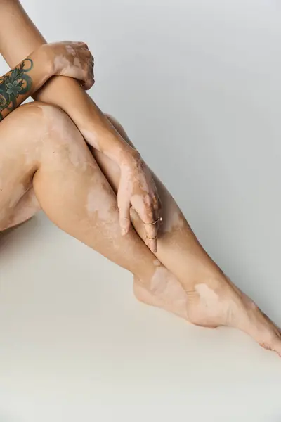 A young woman with vitiligo poses gracefully, showcasing her skin. — Stock Photo
