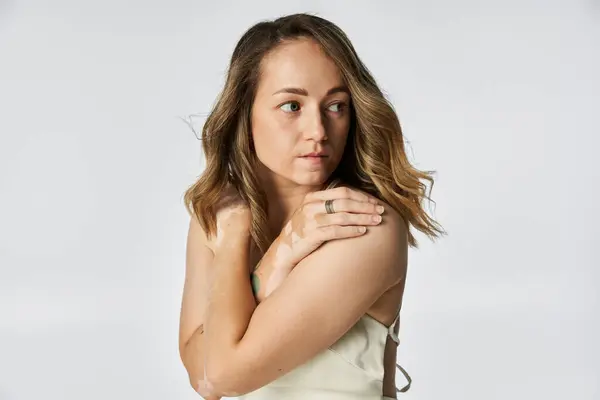 Hermosa joven con vitiligo abraza su singularidad mientras posa suavemente para la cámara. - foto de stock