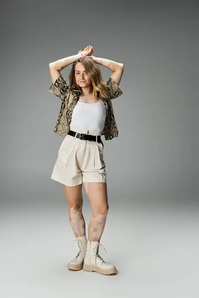 A young woman with vitiligo proudly displays her unique skin in a stylish outfit. — Stock Photo