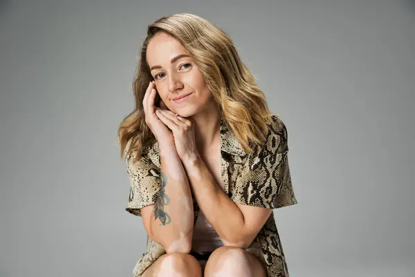 Young woman with vitiligo sits thoughtfully, showcasing her unique beauty and fashion sense. — Stock Photo