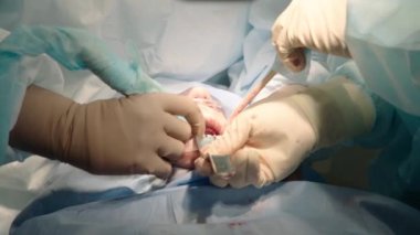 Hastanede ağız cerrahisi yapan özenli doktorları yakından çek. Diş aletleri. Diş sağlığı kliniği. Diş ameliyatı. Yavaş çekim.