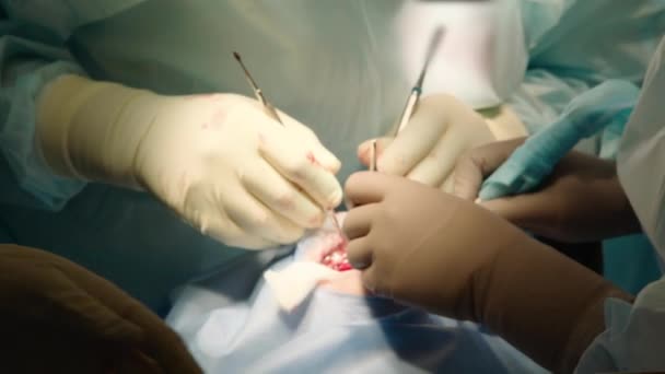 Twee Professionele Artsen Voeren Tandheelkundige Chirurgie Het Plaatsen Van Tandheelkundige — Stockvideo