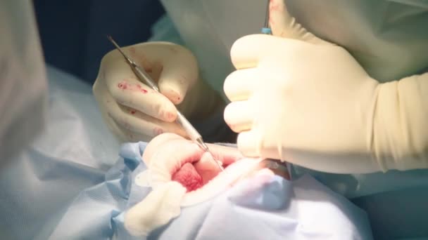 Nahaufnahme Aufmerksamer Aufmerksamer Ärzte Die Oralchirurgie Krankenhaus Durchführen Zahnärztliche Instrumente — Stockvideo