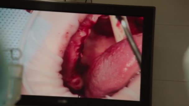 手术室显示器上的医疗和牙科手术实时进行 — 图库视频影像
