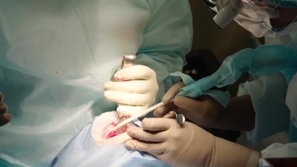 Imagem Perto Médicos Atenciosos Que Realizam Cirurgia Oral Hospital Instrumentos — Vídeo de Stock