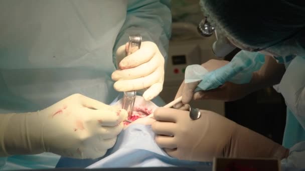 Zbliżenie Zdjęcia Uważnych Lekarzy Wykonujących Operacje Jamy Ustnej Szpitalu Instrumenty — Wideo stockowe