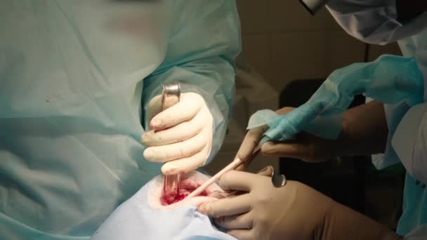 Detailní Záběr Pozorných Pozorných Lékařů Provádějících Orální Chirurgii Nemocnici Zubní — Stock video