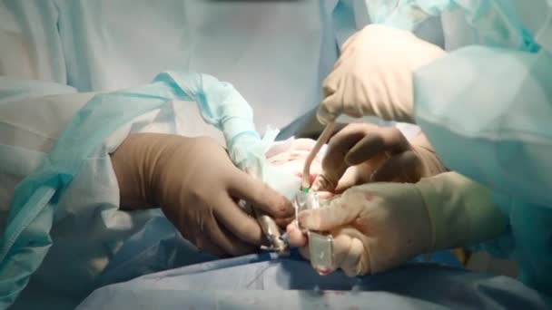 Крупный План Внимательных Внимательных Врачей Выполняющих Оральную Хирургию Больнице Стоматологические — стоковое видео