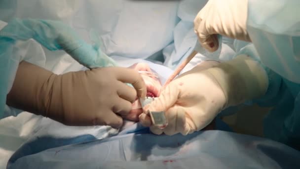 Primer Plano Médicos Atentos Atentos Que Realizan Cirugía Oral Hospital — Vídeos de Stock