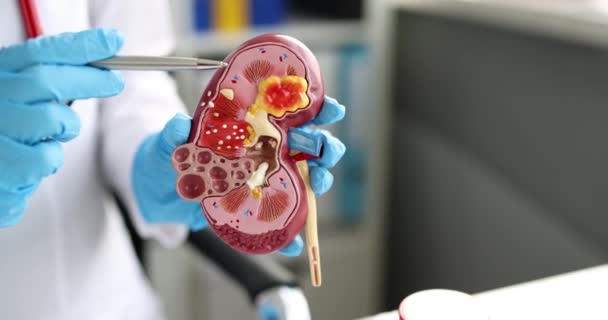 泌尿器科医は腎臓の構造をレイアウトで示しています 腎臓病の症状や概念を引き起こす — ストック動画