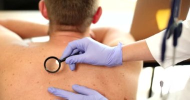 Büyüteçle adamın sırtındaki benleri kontrol ediyorum. Nevus türleri semptomlara neden olur.