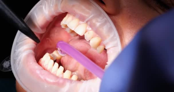 Jovem Com Afastador Boca Clínica Odontológica Dentista Que Usa Ejetor — Vídeo de Stock