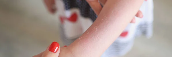 子供の腕の上に赤い発疹を検討する女性のクローズアップ 女の子の体に刺激 病気の概念 — ストック写真