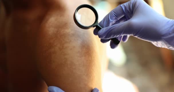 医生用放大镜检查病人的背部和肩部皮肤色素沉着 黑色素瘤的外科治疗 — 图库视频影像