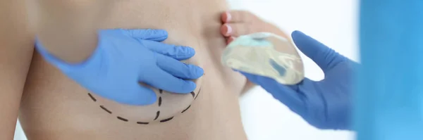 Plastický Chirurg Drží Silikonový Hrudní Implantát Pro Zvětšení Prsou Plastická — Stock fotografie