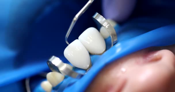 医生正牙牙医在病人的牙齿特写上固定假牙 4K片慢动作 牙科修复概念 — 图库视频影像