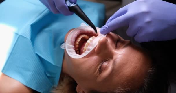 Diş Kliniğinde Ağzı Retraktörlü Dişlerini Suyla Fırçalayan Bir Kadın Diş — Stok video