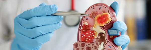Close-up of urologist pointing pen kidney structure on anatomical model. Treatment of kidney diseases, pyelonephritis