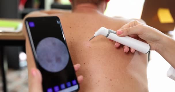 Läkaren Undersöker Födelsemärket Mannens Rygg Slowmotion Närbild Dermatologiskt Besök Medicinteknisk — Stockvideo