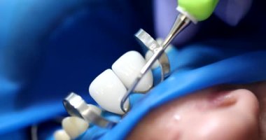 Doktor ortodontist hastanın ön dişlerine kaplama takıyor. 4K filmi yavaş çekimde çekiyor. Diş protezi konsepti