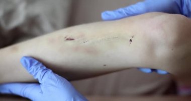 Diz çizikleri ve eldivenli doktorun ellerinde çok acı verici bir yara. Çocuklar dizlerinin üstüne çöküp, ciltlerinde morluklar oluşmuş.