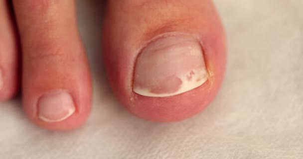 用钉子霉菌和一只受伤的白色钉子堵住脚 指甲从甲床中分离出来的胆囊炎 — 图库视频影像