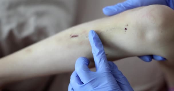 Ferida Arranhada Com Sangue Perna Médico Cura Lesões Infantis Contusões — Vídeo de Stock