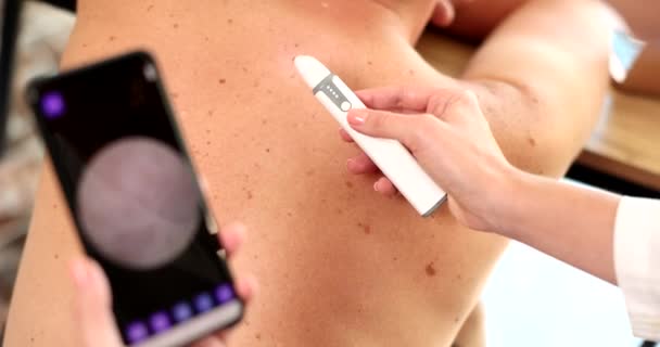 Metodo Dermatoscopia Formazioni Della Pelle Esame Talpe Dorso Maschile Prevenzione — Video Stock
