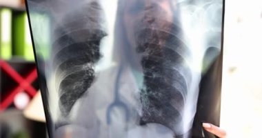 Doktor klinikteki akciğerlerin röntgenine bakıyor. Zatürree teşhisi ve tedavisi