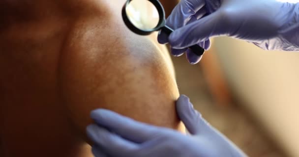 Dokter Dermatoloog Onderzoek Van Huid Van Patiënt Met Vitiligo Ziekte — Stockvideo