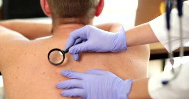 Dermatolog, klinikte büyüteç takan bir hastanın doğum lekesini ve doğum lekesini inceliyor. Benlerin ve neoplazmaların dermoskopisi