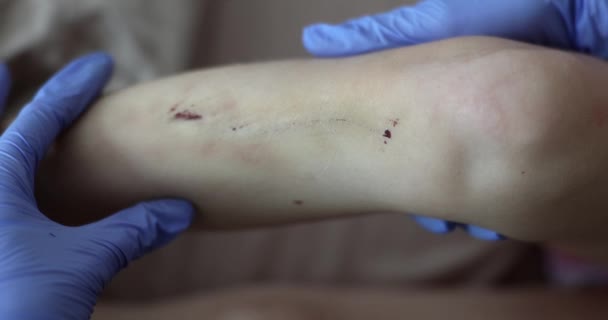 Doctor Conducts Medical Examination Child Leg Scratches Wounds Healing Wounds — Stock Video