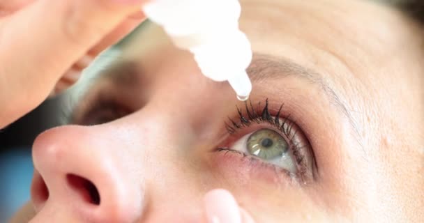 Κλείσιμο Της Γυναίκας Ρίχνει Σταγόνες Στο Κόκκινο Μάτι Επιπεφυκίτιδα Γλαύκωμα — Αρχείο Βίντεο