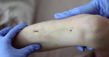 Wounds scratches abrasions on skin of child leg. Doctor examining a scratch on skin