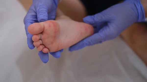 Rash with enterovirus infection of the picornavirus family on feet of child. Medicine rash allergy coronovirus in child