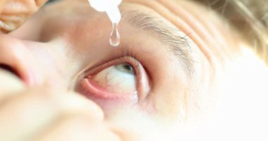 Man instilling eye drops from allergies closeup 4k movie slow motion. Viral conjunctivitis treatment concept 