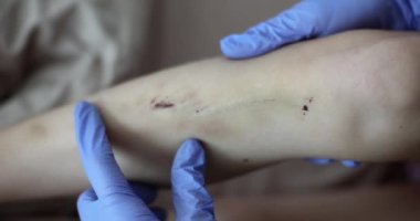 Doctor examining abrasions and bruises on child leg closeup 4k movie slow motion. Forensic-medical examination concept 