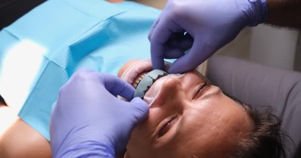 Dentist Trying Dental Cast Patient Teeth Dental Prosthetics Veneers — Stockvideo