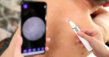 Method of dermatoscopy of skin formations and moles. Melanoma and skin cancer prevention and skin screening