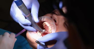 Dişçilerin elleri bir kadının dişlerini aletle fırçalar, yakın çekim. Klinikte diş tedavisi