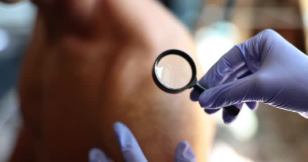 Arzt Dermatologe Untersuchung Hautausschlag Auf Der Haut Mit Lupe Nahaufnahme — Stockvideo
