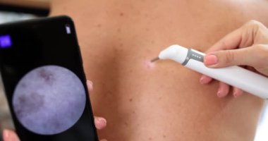 Onkolojist, hastanın doğum lekesini dijital dermatoskopla inceliyor. Benlerin ve neoplazmaların dermoskopisi