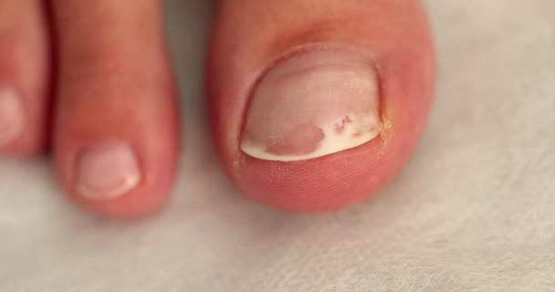 Gros Plan Femme Abîmée Ongle Pied Infection Des Ongles Orteil — Video