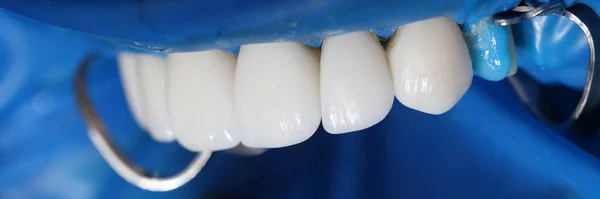 Installation of veneers and dental implants in clinic closeup. Dental prosthetics concept