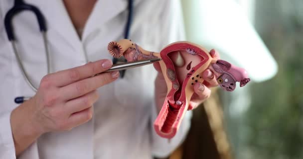 Läkare Gynekolog Innehar Anatomisk Modell Kvinnliga Reproduktiva Organ Hysteroskopi Och — Stockvideo