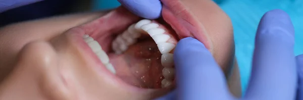 Doctor dentist examining patient oral cavity with veneers closeup. Installation of composite and zirconium veneers concept