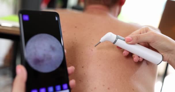 Dermatolog Bada Skórę Pacjenta Pomocą Cyfrowego Dermatoskopu Ekranu Smartfona Metoda — Wideo stockowe